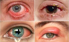 Cách phòng bệnh đau mắt đỏ|https://kiemsoatbenhtatbacgiang.vn/zh_CN/chi-tiet-tin-tuc/-/asset_publisher/M0UUAFstbTMq/content/cach-phong-benh-au-mat-o