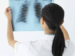 Dấu hiệu và cách phòng chống bệnh lao phổi